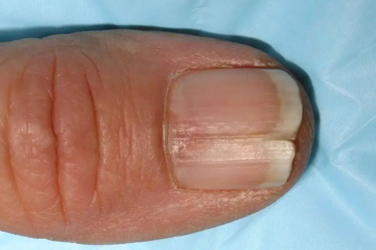 splitting nails