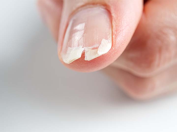 nail breakage